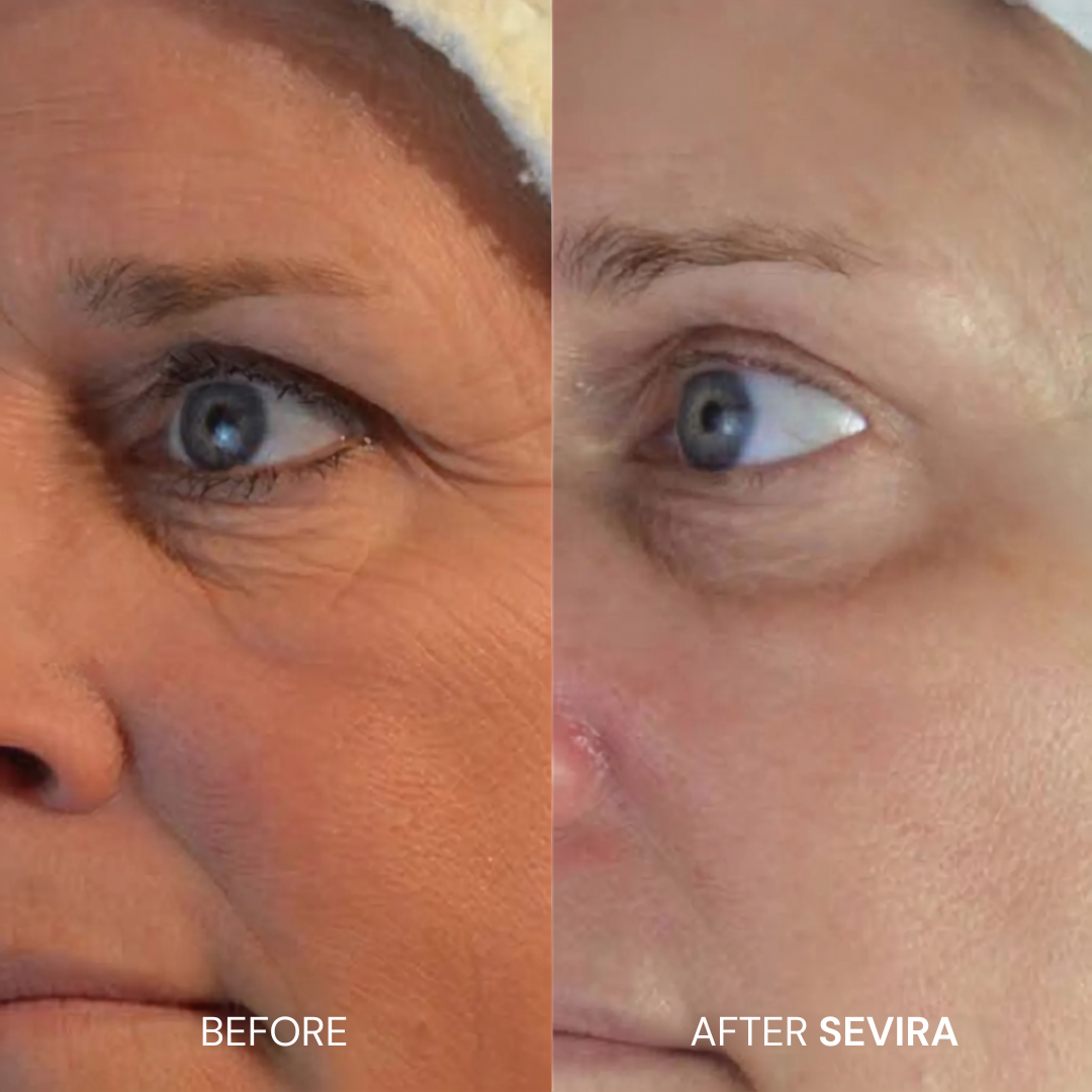 Sevira MicroRenew