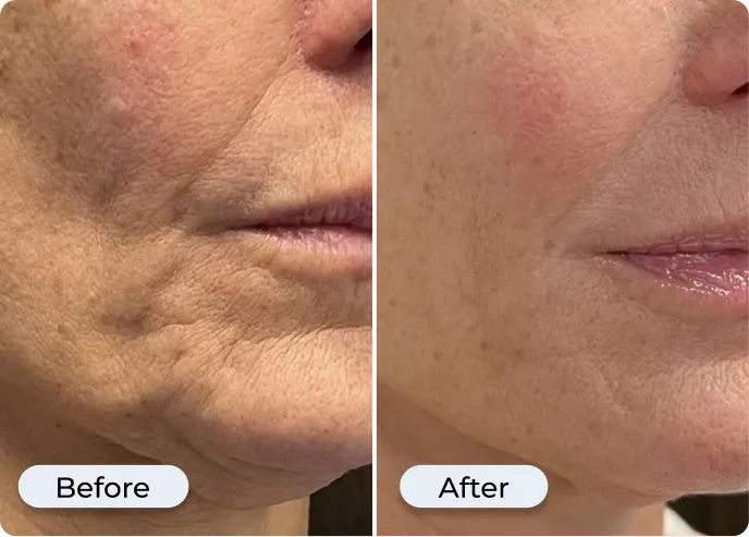 Goodbye Deep Wrinkles