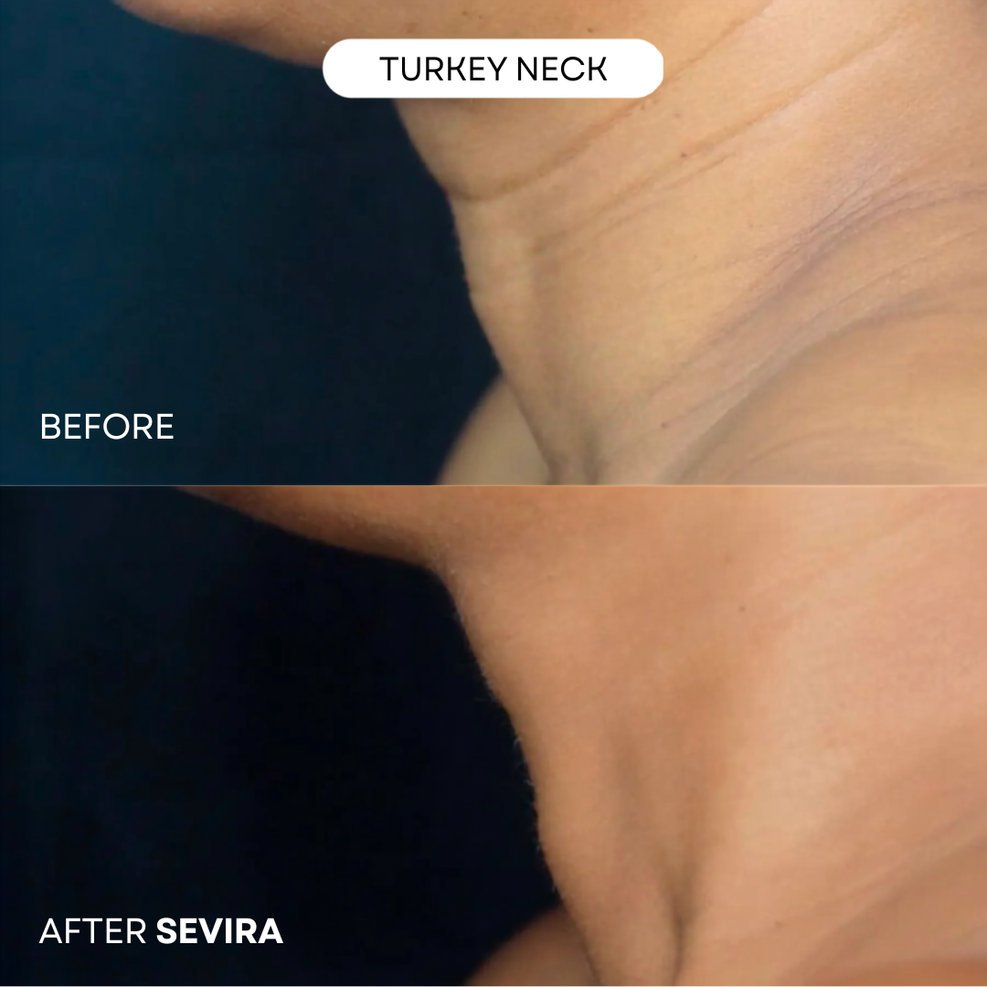 Sevira MicroRenew